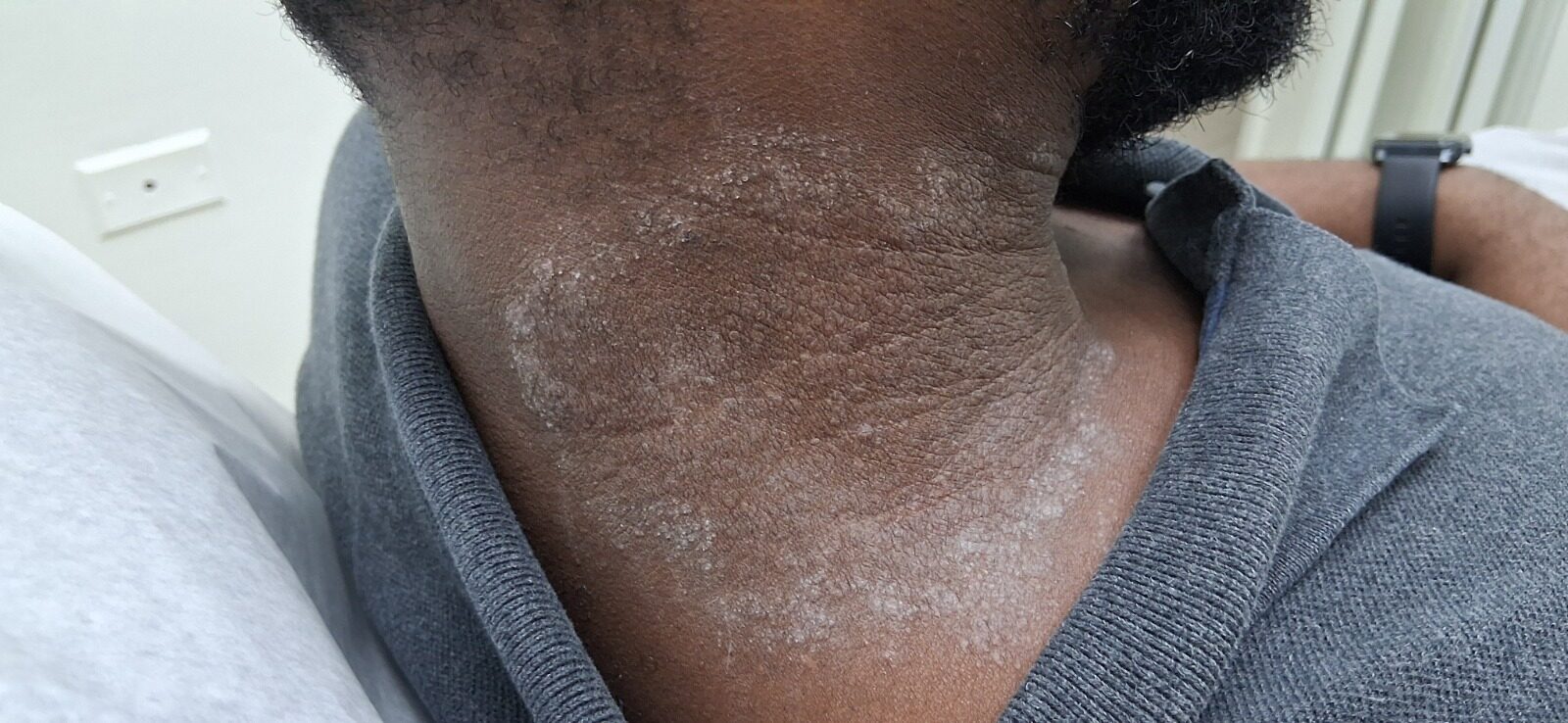 Caso clínico de Dermatitis por contacto