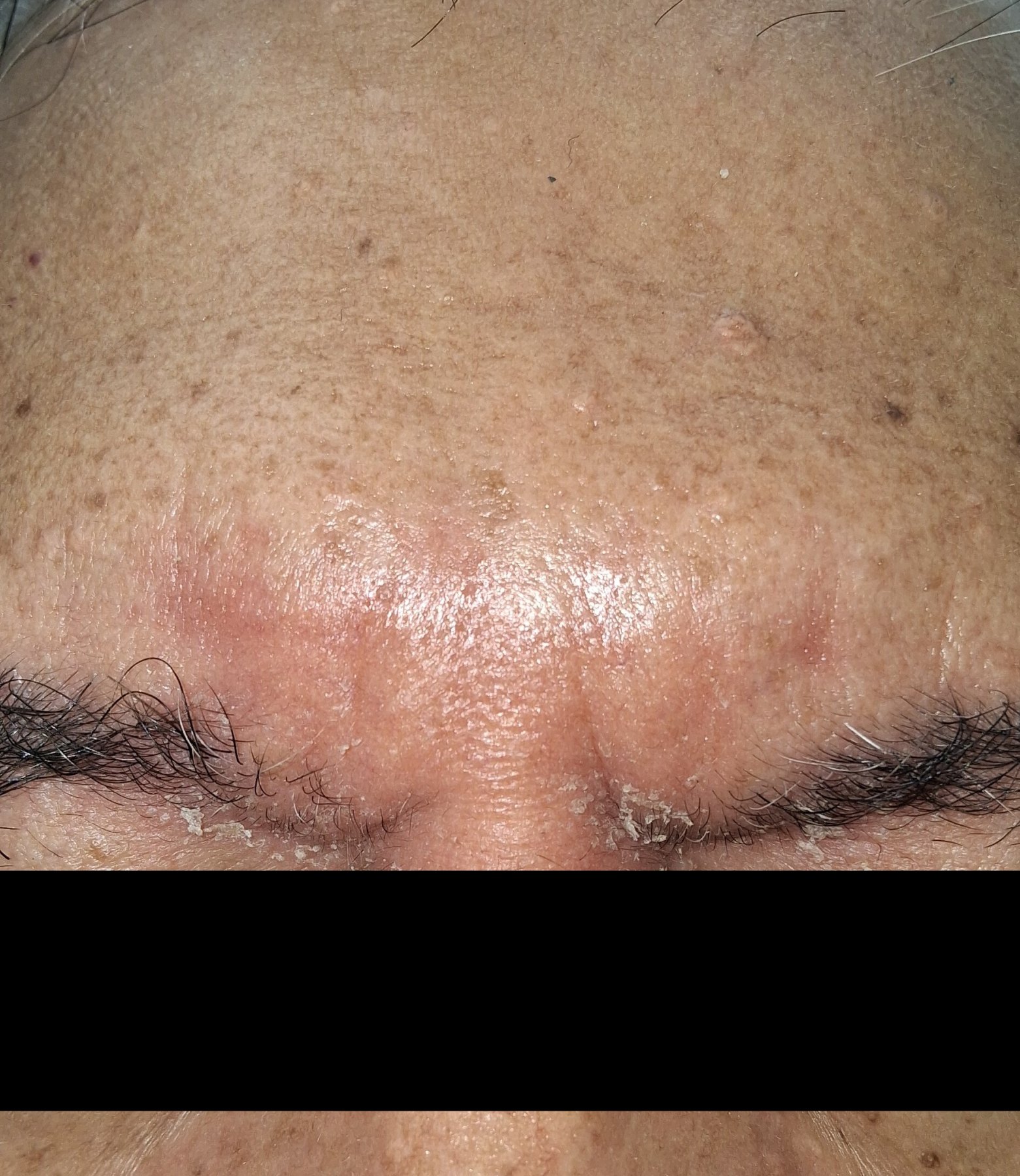 Dermatitis seborreica: imagen antes