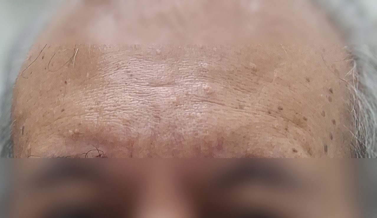 Dermatitis seborreica: imagen después