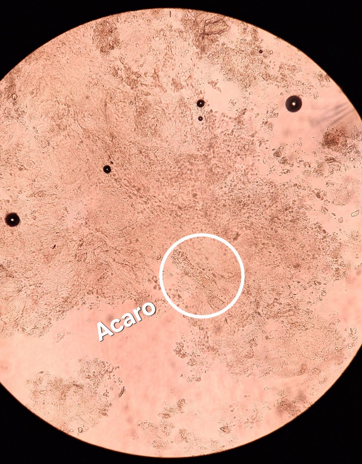 Caso clínico de Dermatitis seborreica
