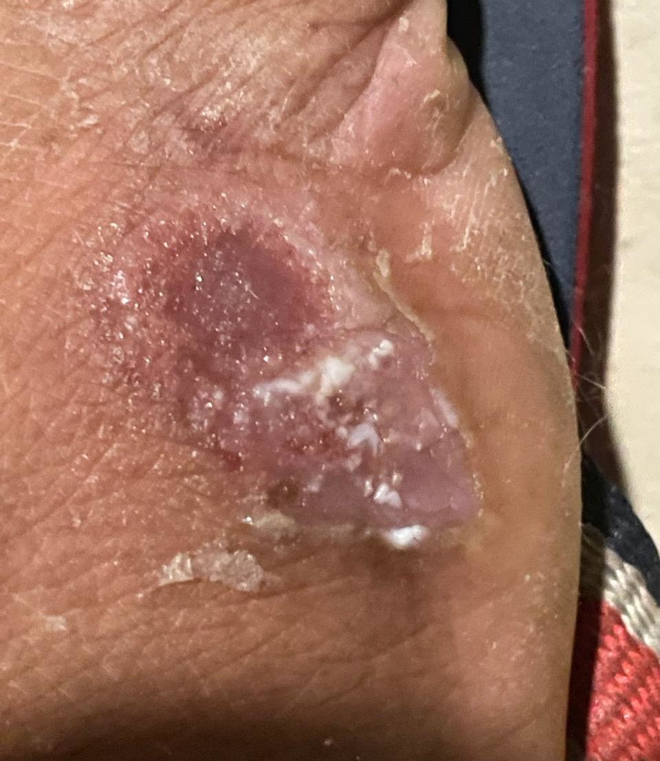 Caso clínico de Dermatitis