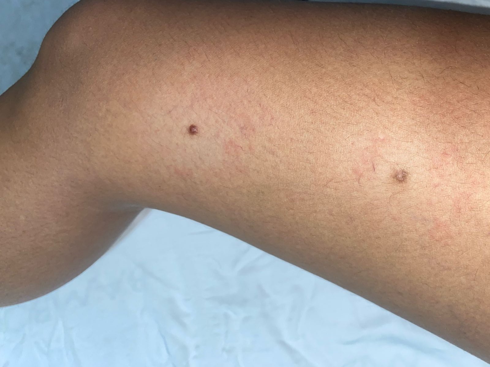 Dermatofibroma y queloide: imagen antes