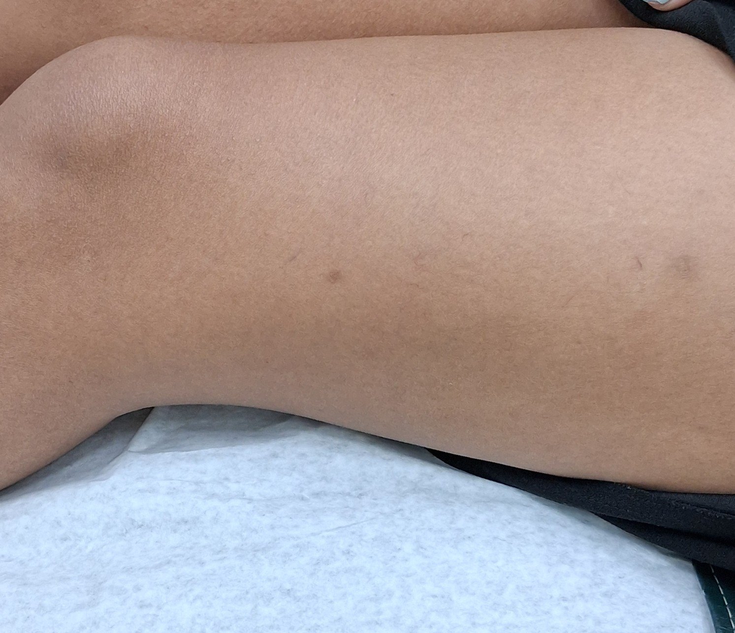Dermatofibroma y queloide: imagen después