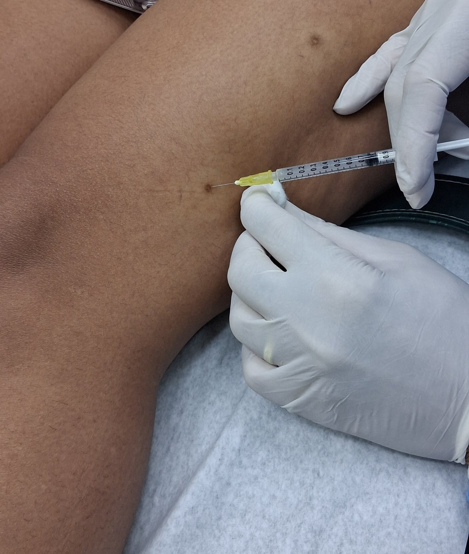 Caso clínico de Dermatofibroma y queloide