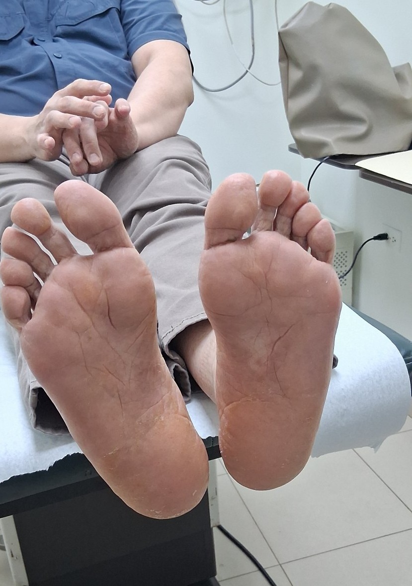 Dishidrosis: imagen después