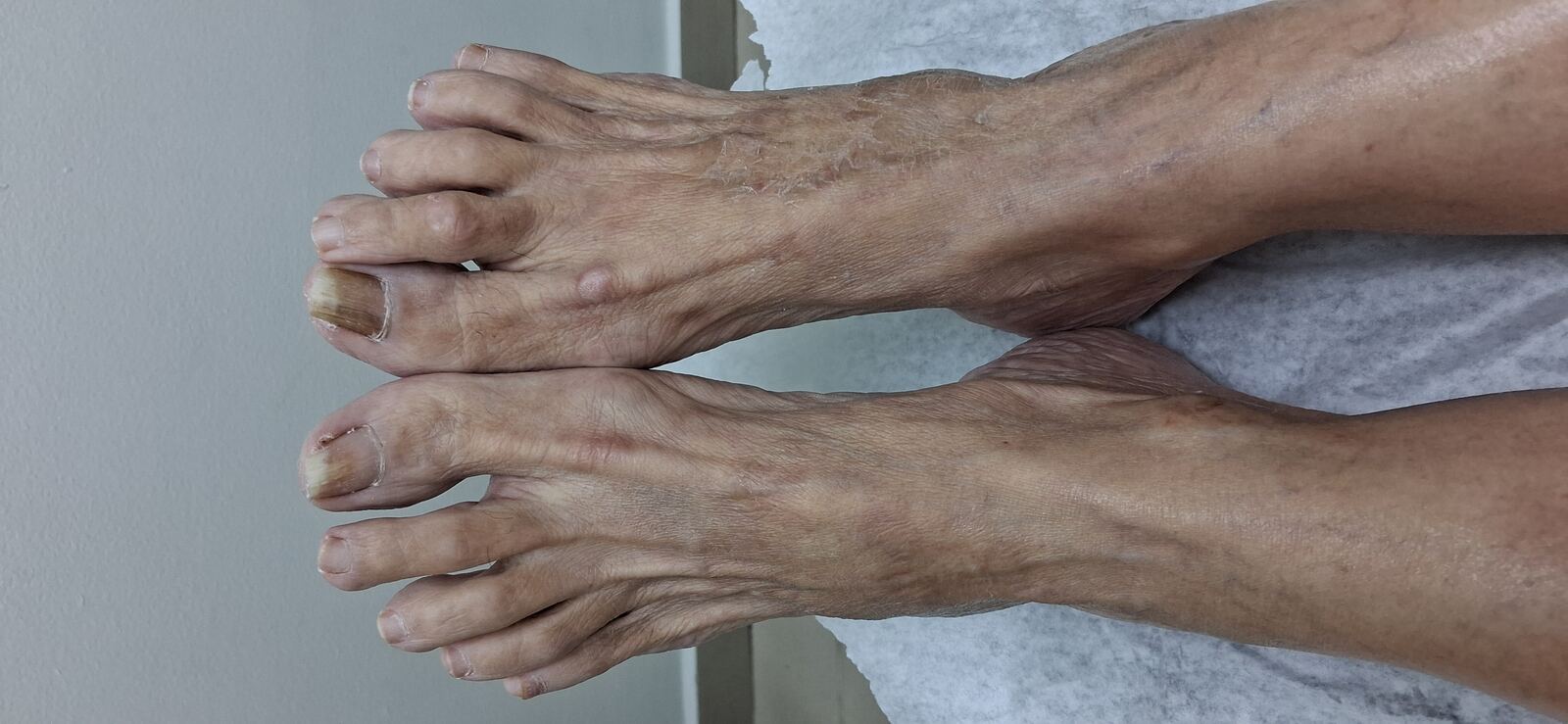 Caso clínico de Disqueratosis