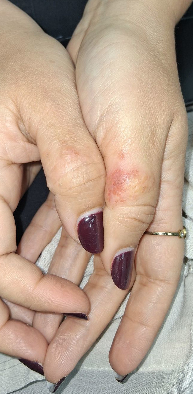 Eczema atópico: imagen antes