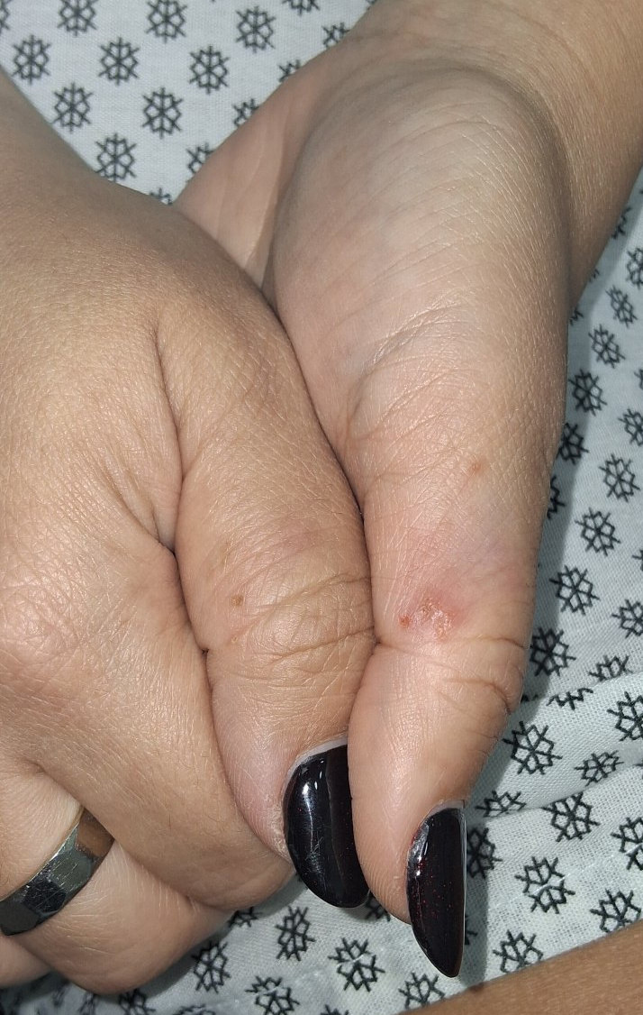 Eczema atópico: imagen después