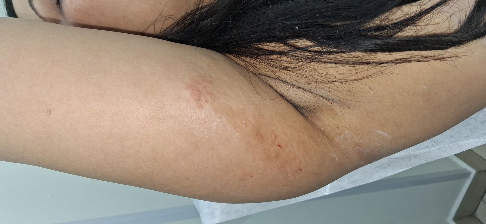 Caso clínico de Eczema atópico