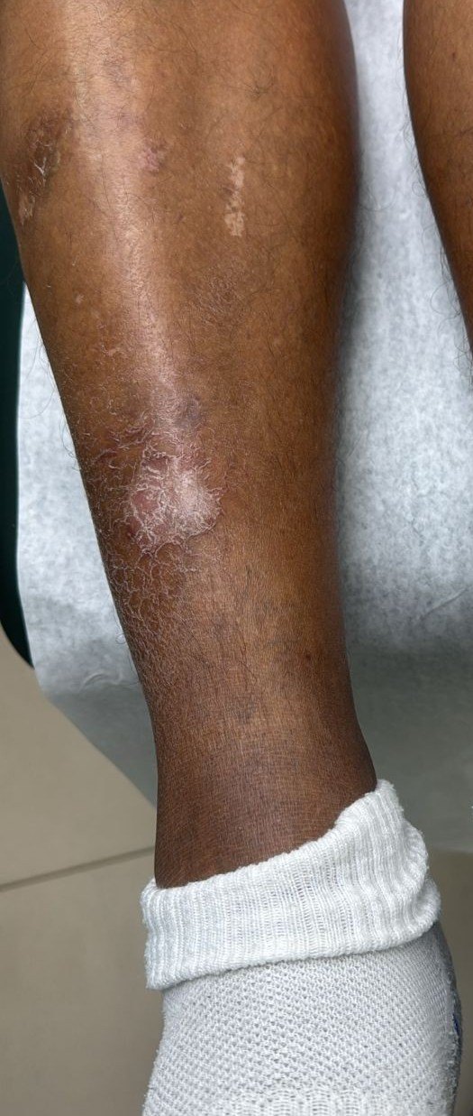 Eczema de estasis y dermatitis craquelé: imagen antes