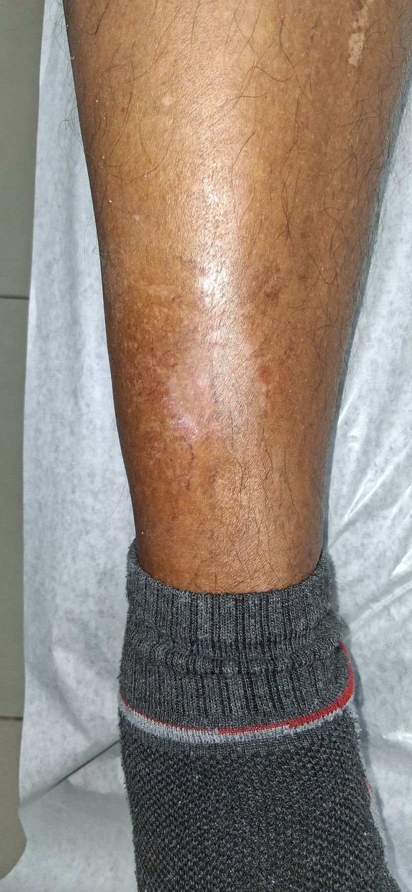 Eczema de estasis y dermatitis craquelé: imagen después
