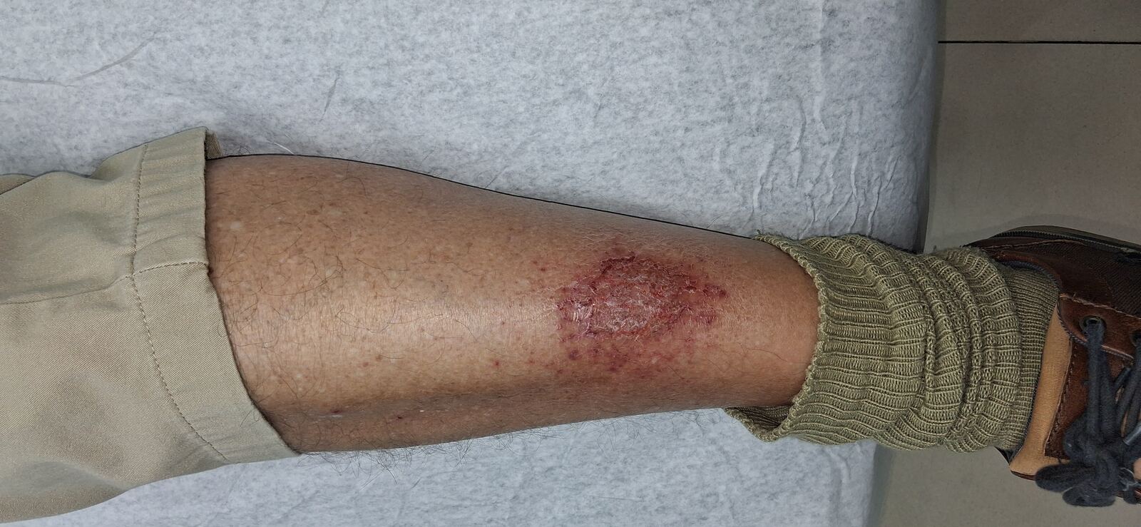 Caso clínico de Eczema de estasis y dermatitis craquelé