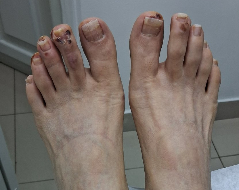 Eczema dishidrótico: imagen antes