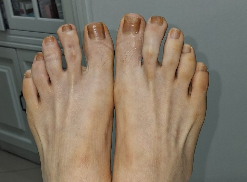 Eczema dishidrótico: imagen después