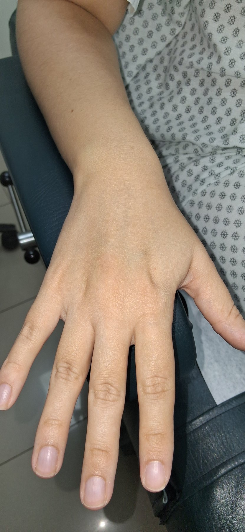Eczema numular vs tiña corporis: imagen después