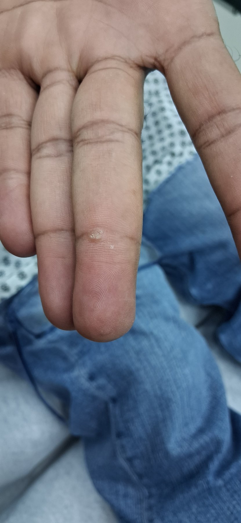 Fibroqueratoma vs verruga: imagen antes