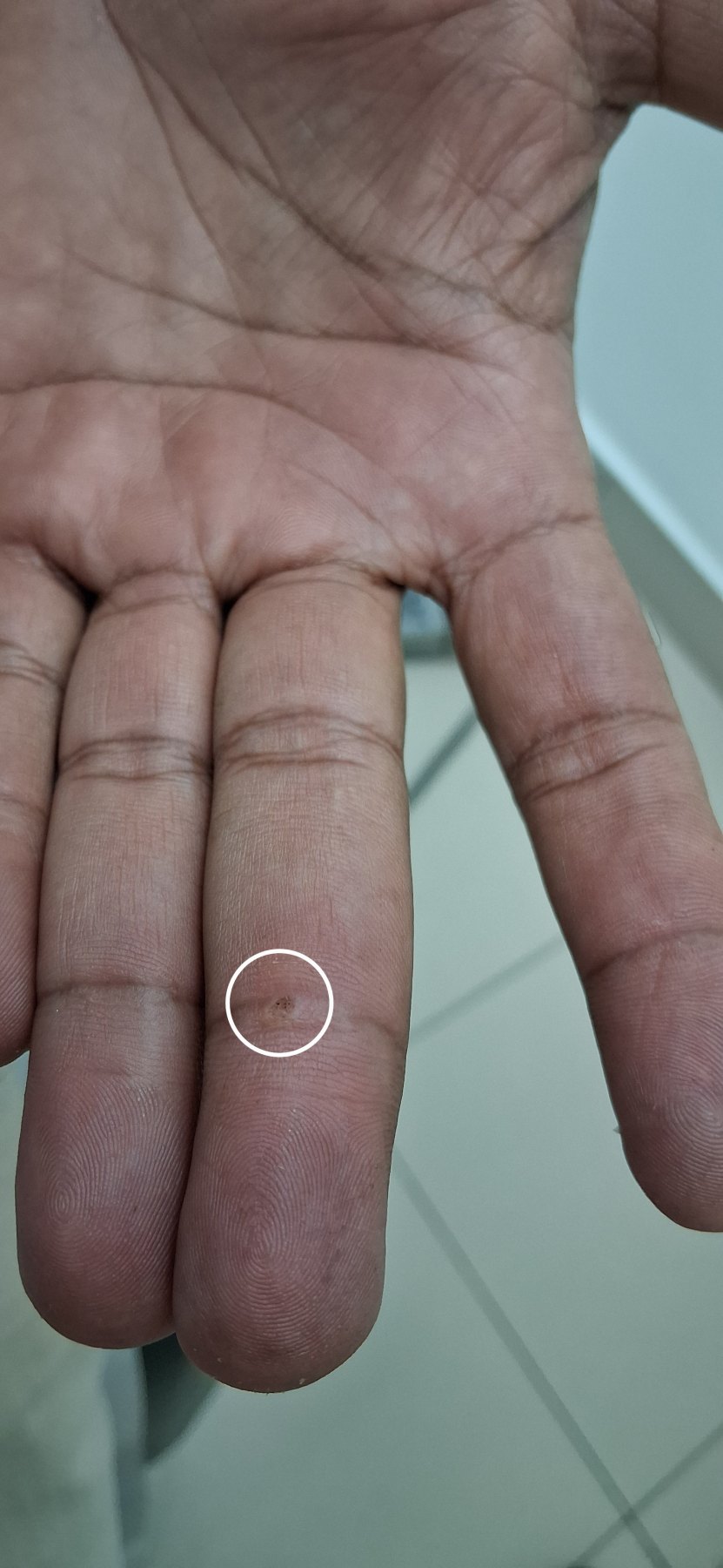Caso clínico de Fibroqueratoma vs verruga