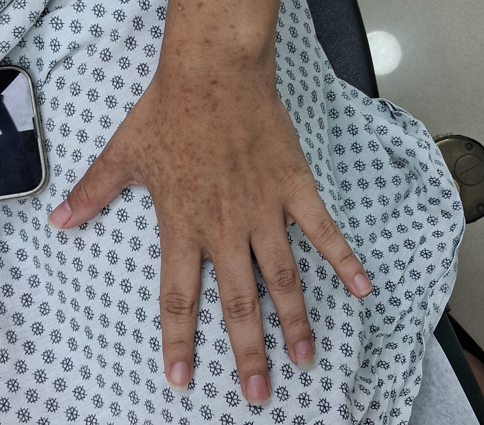 Fitofotodermatitis: imagen antes