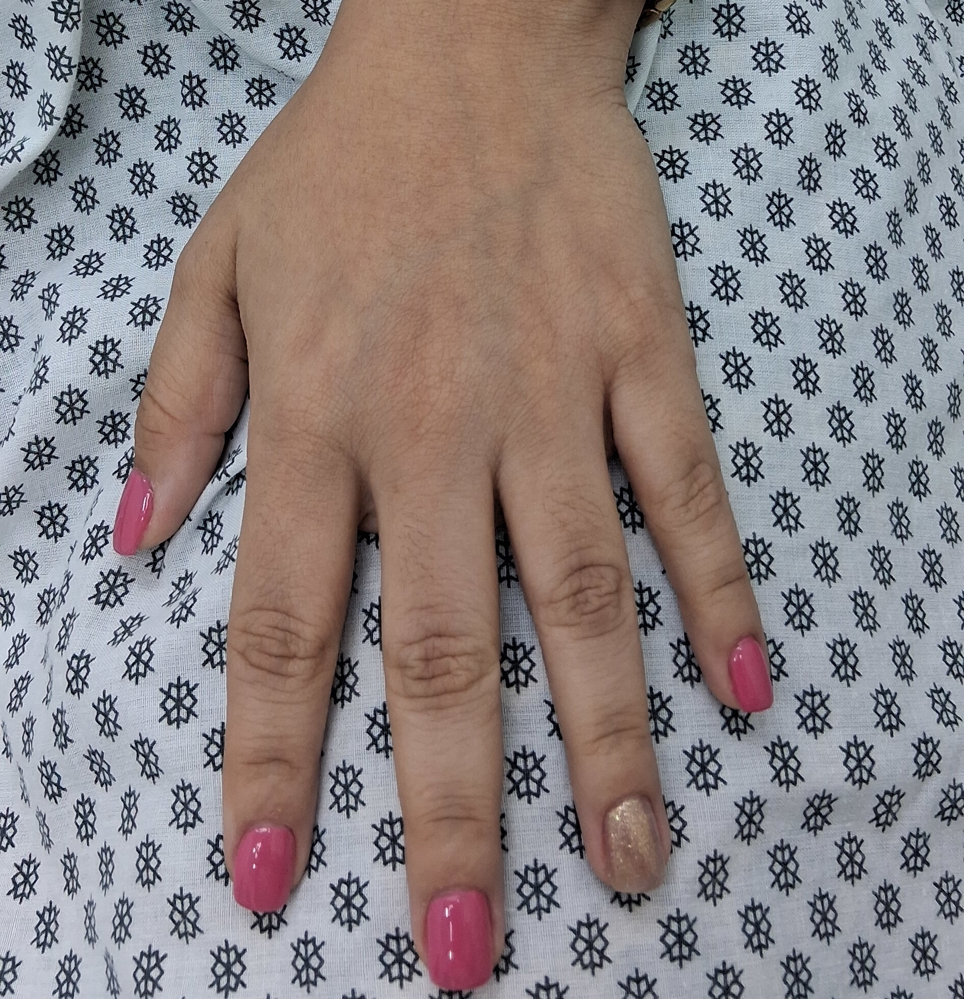 Fitofotodermatitis: imagen después