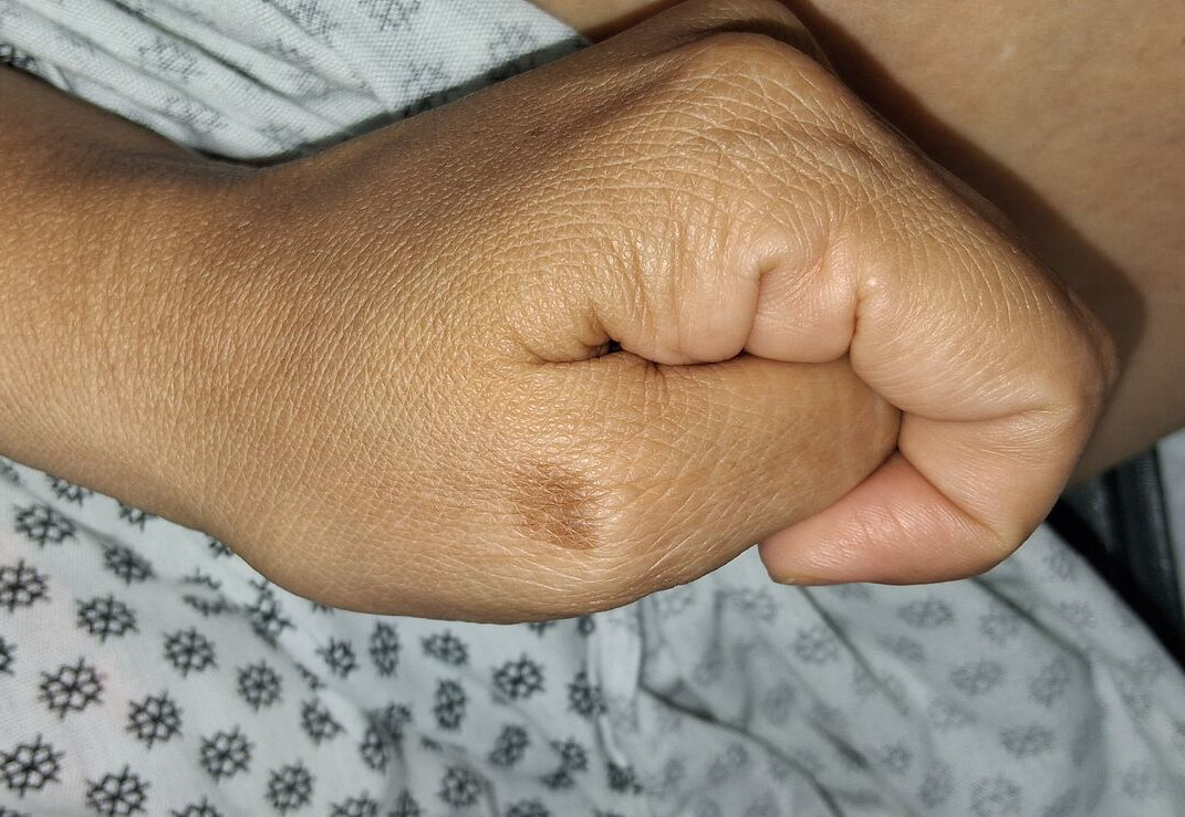 Caso clínico de Fitofotodermatitis