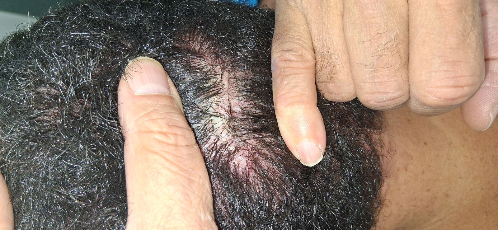 Foliculitis decalvante: imagen antes
