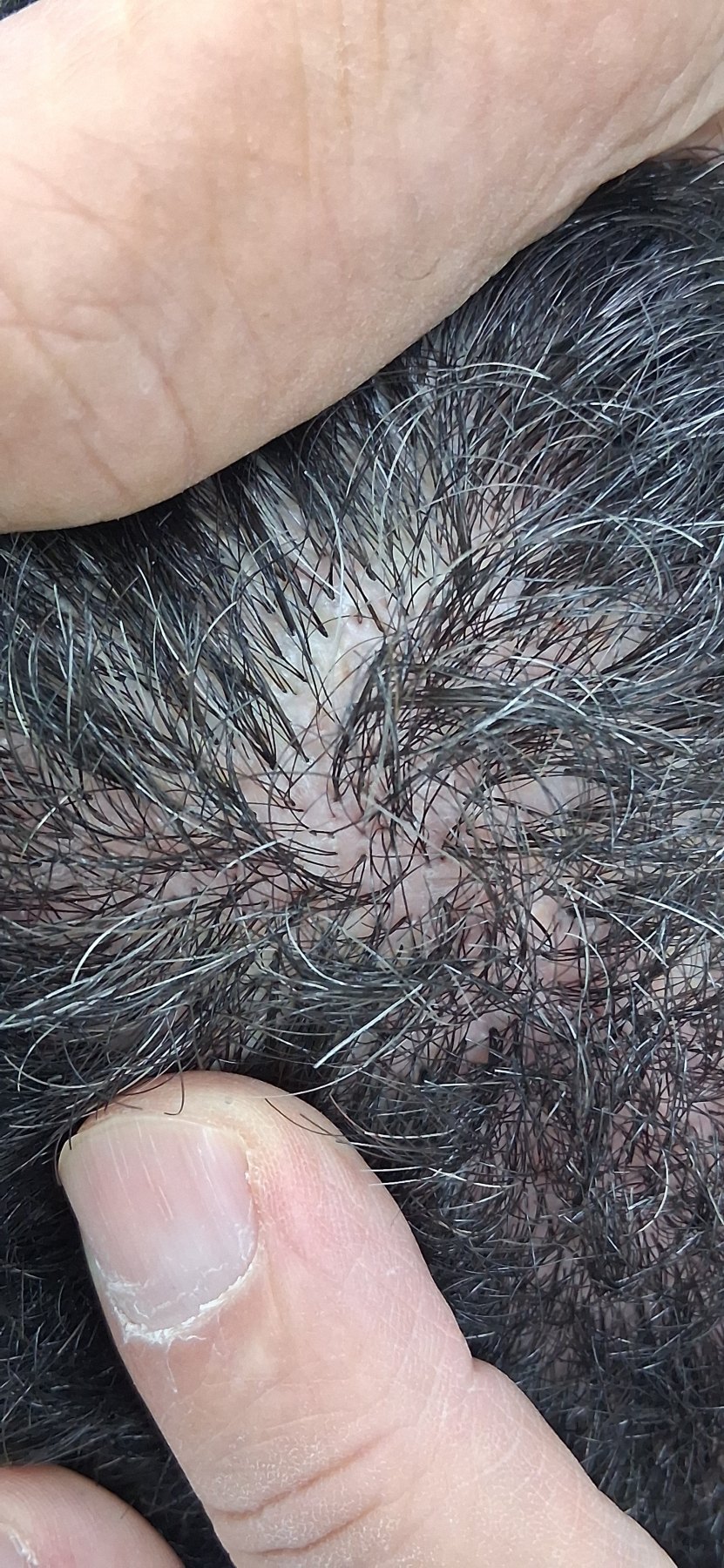 Foliculitis decalvante: imagen después