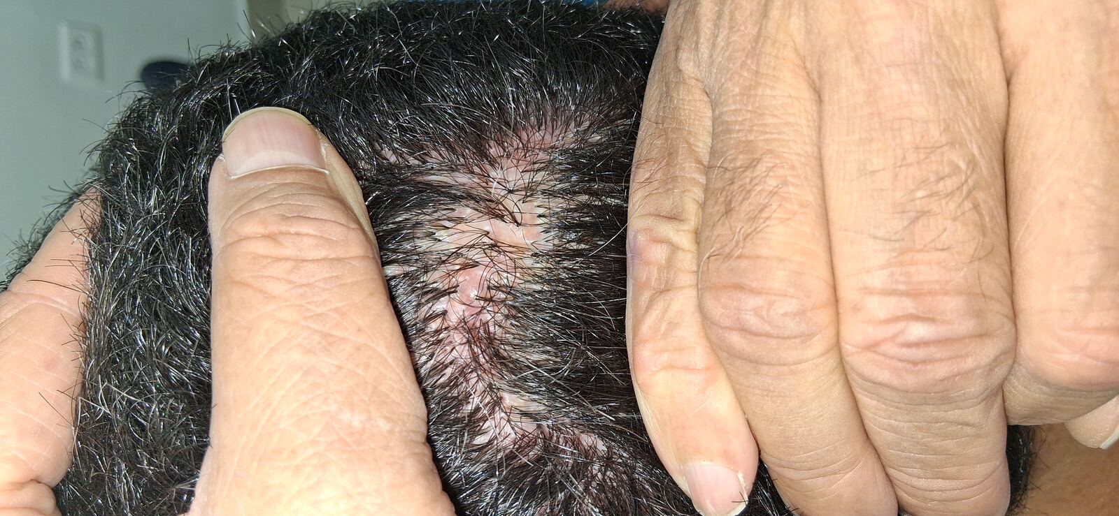 Caso clínico de Foliculitis decalvante