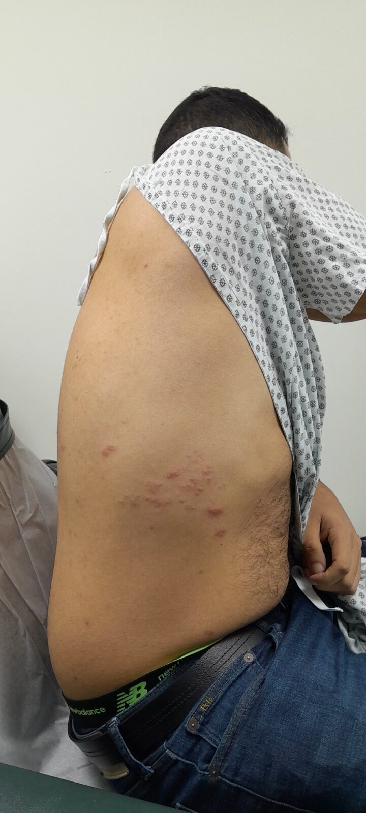 Herpes zoster: imagen antes