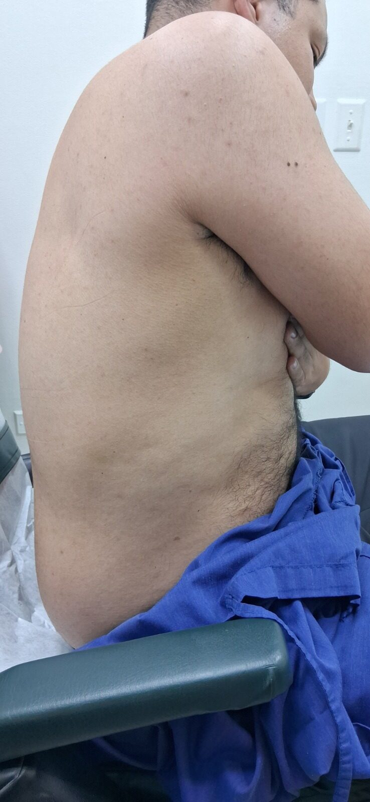 Herpes zoster: imagen después