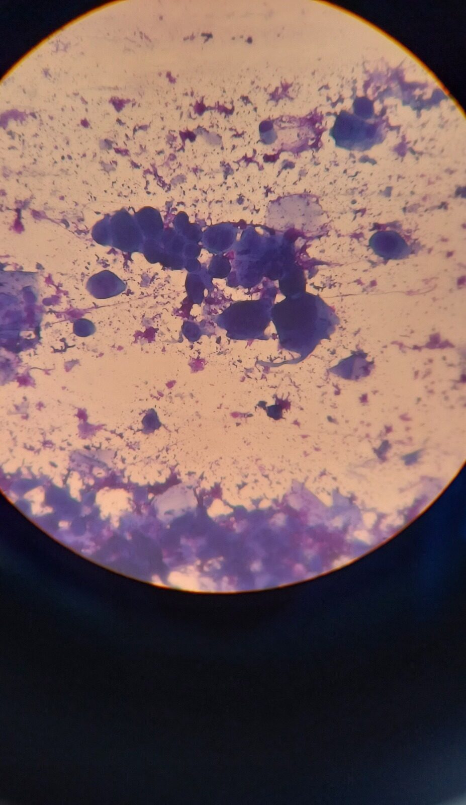 Caso clínico de Herpes zoster
