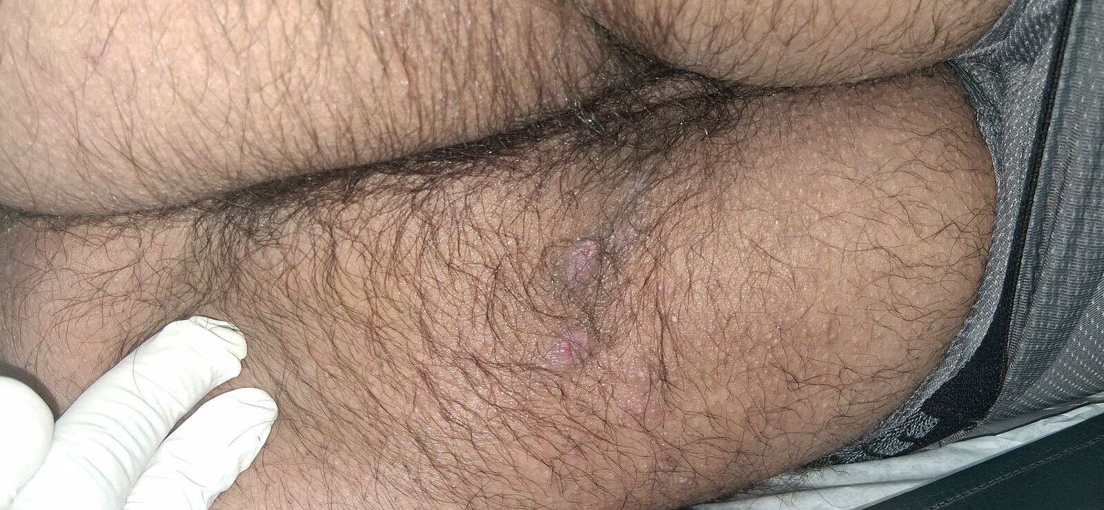 Hidradenitis supurativa: imagen antes