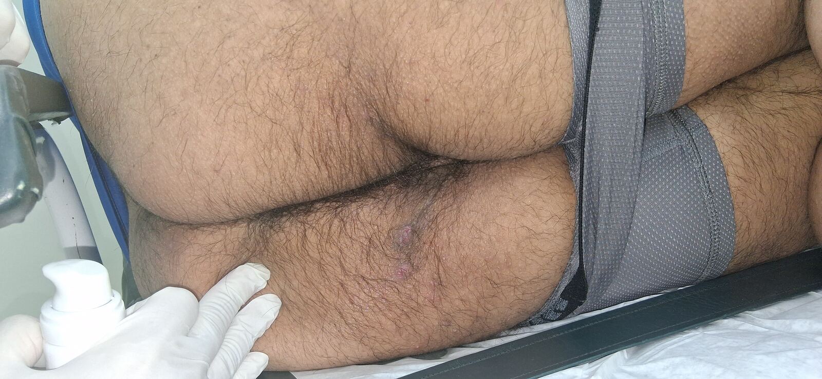 Caso clínico de Hidradenitis supurativa