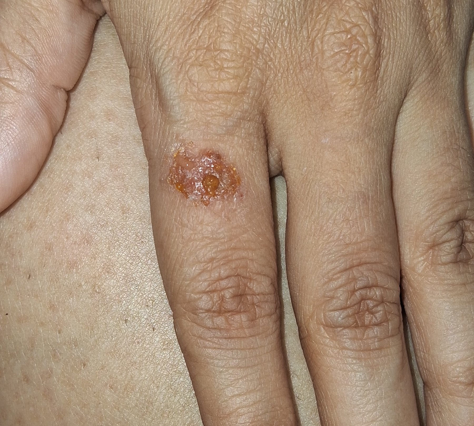 Caso clínico de Impétigo contagioso
