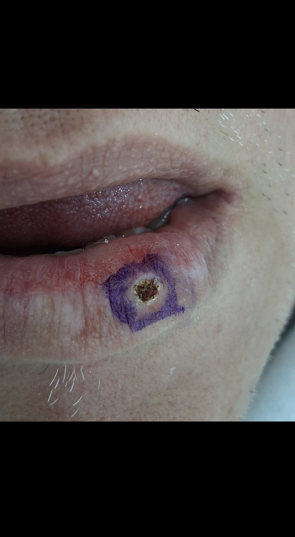 Lago venoso vs nevus: imagen después