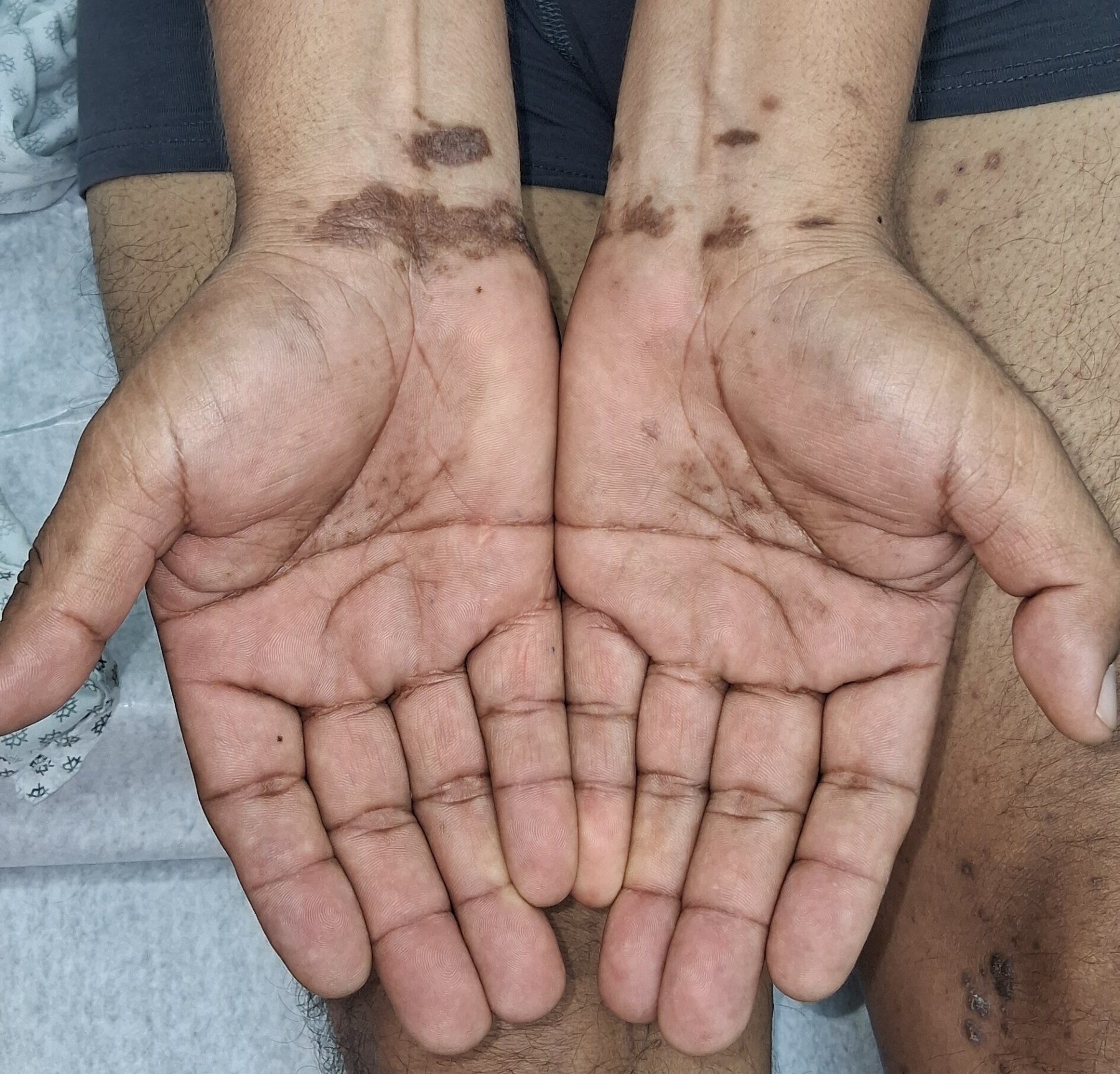 Caso clínico de Liquen plano