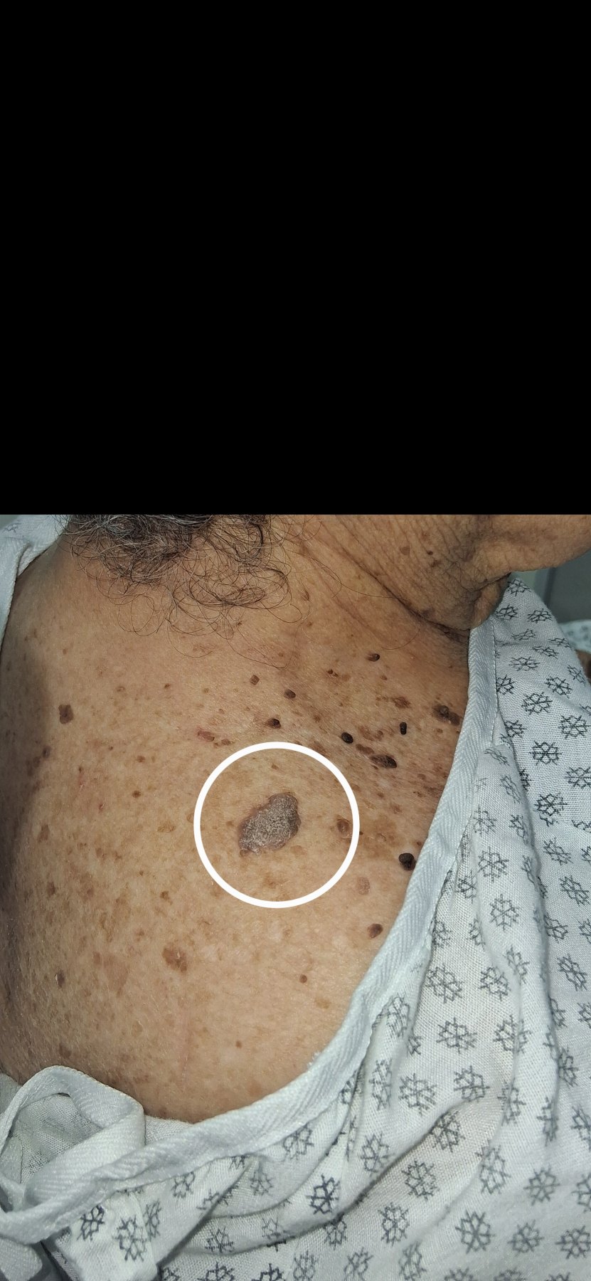 Melanoacantoma: imagen antes