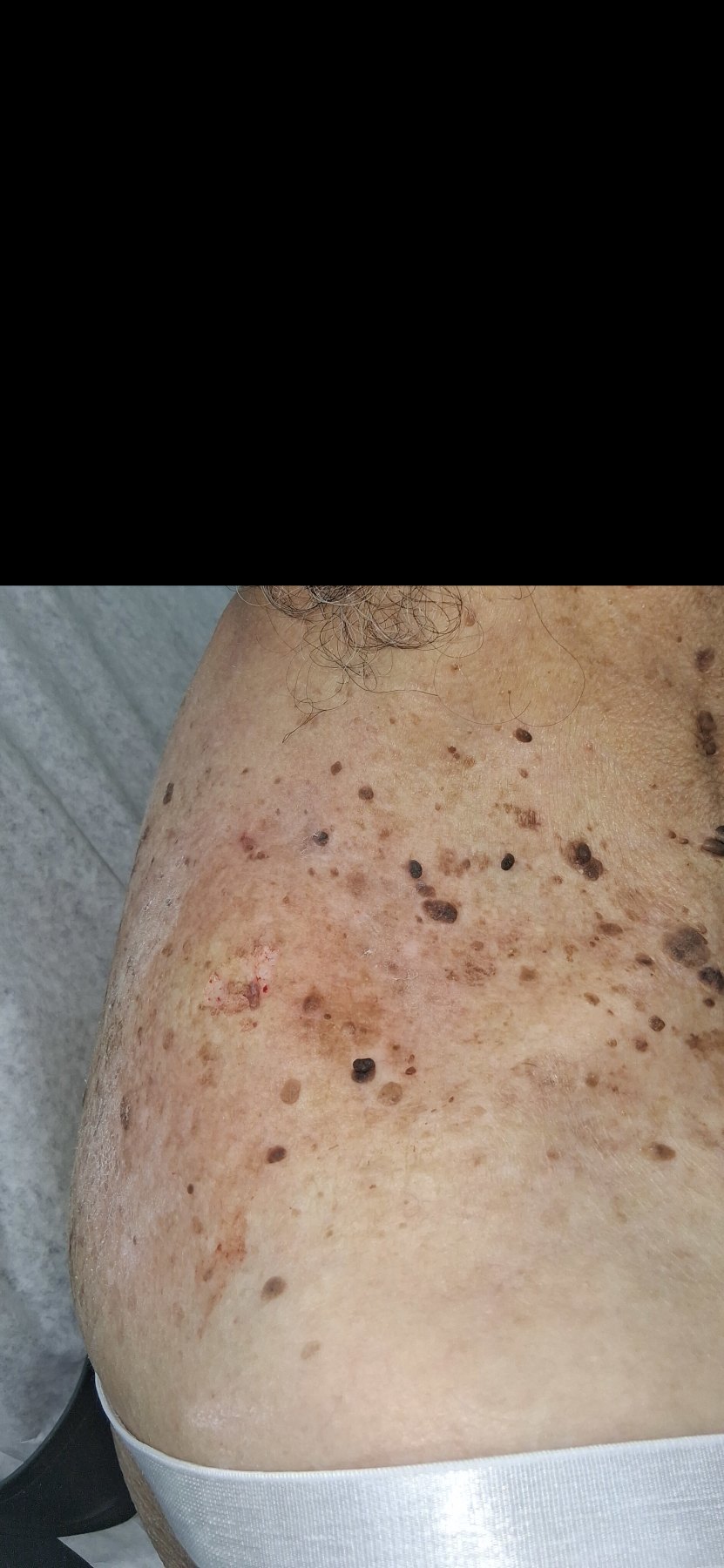 Melanoacantoma: imagen después