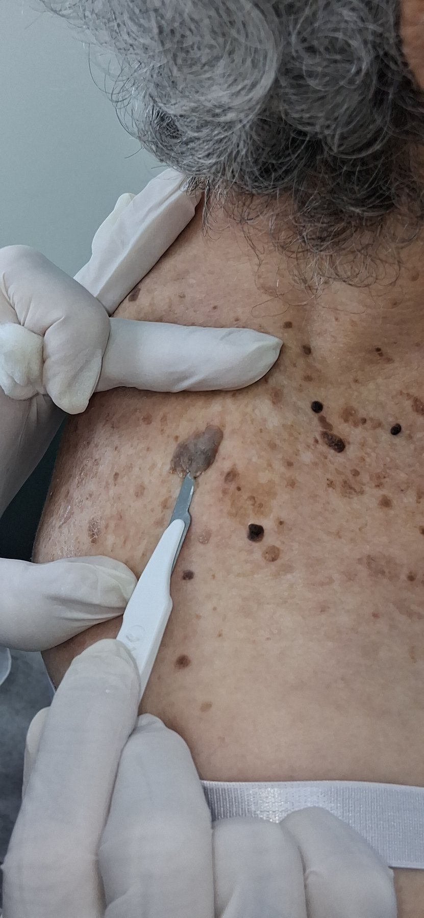 Caso clínico de Melanoacantoma