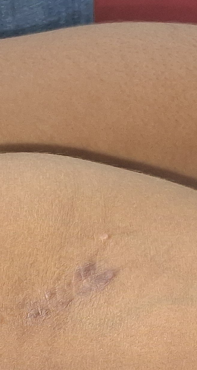 Molusco contagioso: imagen después