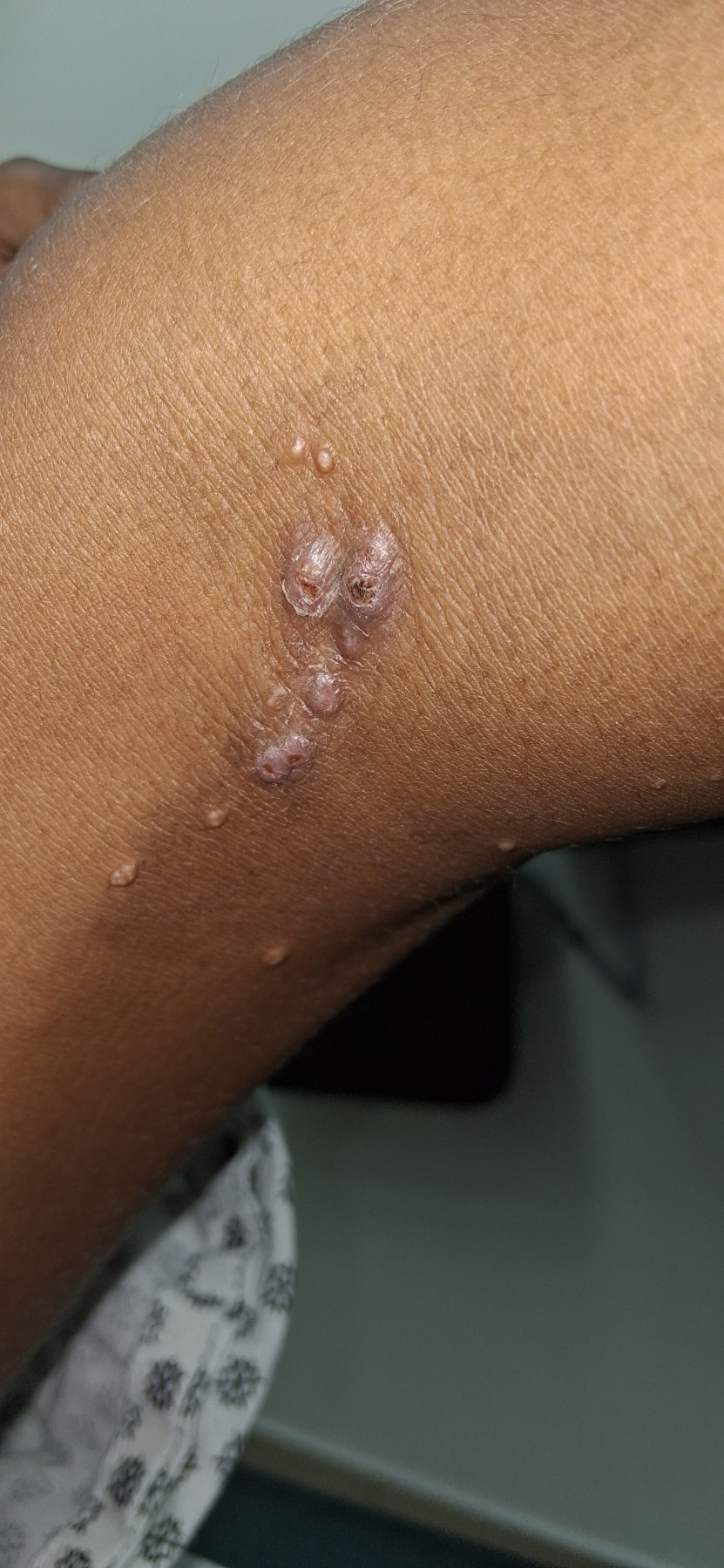 Caso clínico de Molusco contagioso