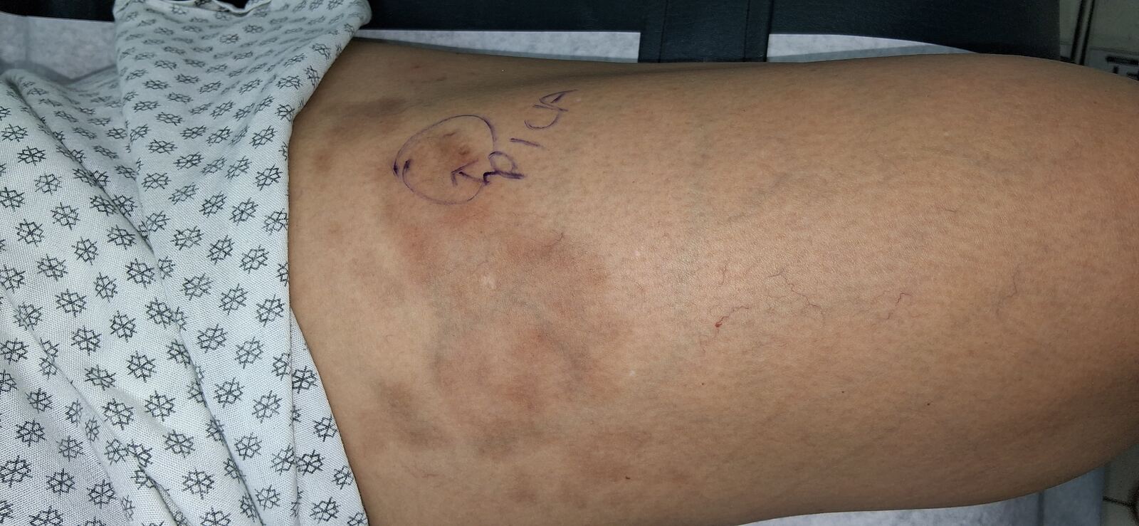 Morfea: imagen antes