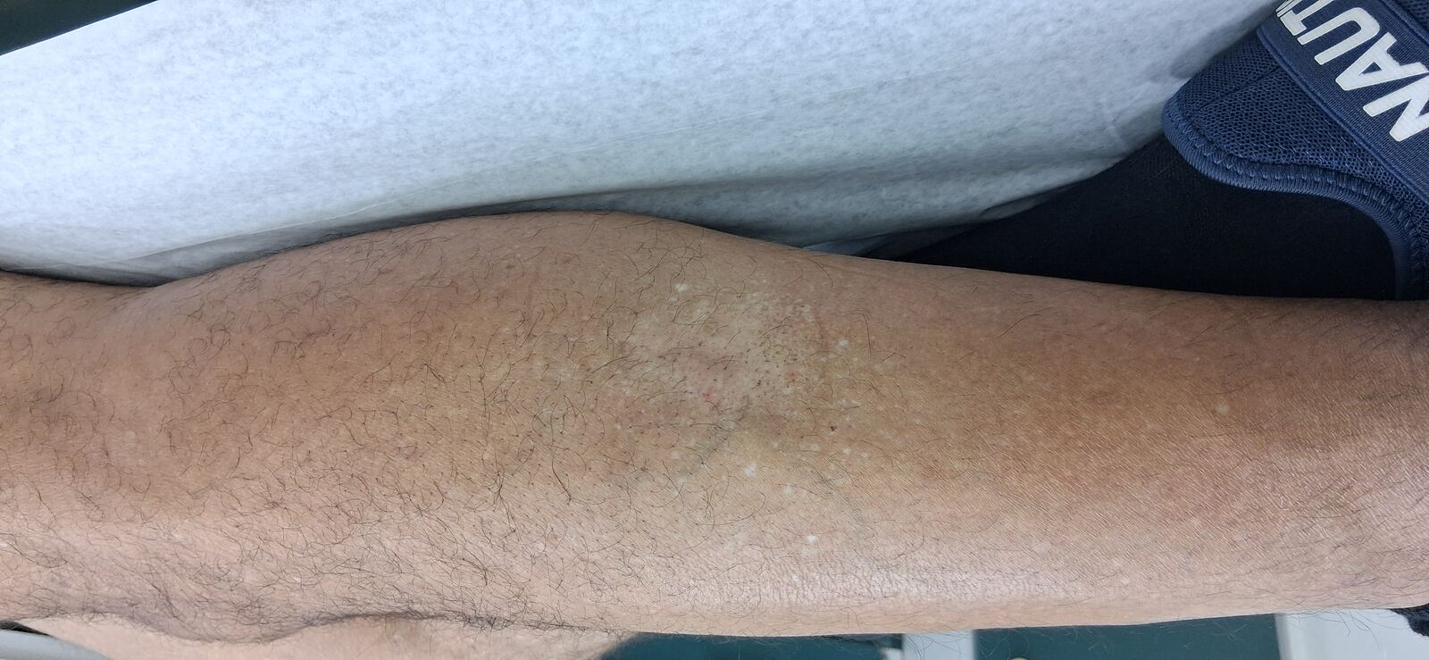 Neurodermatitis: imagen antes