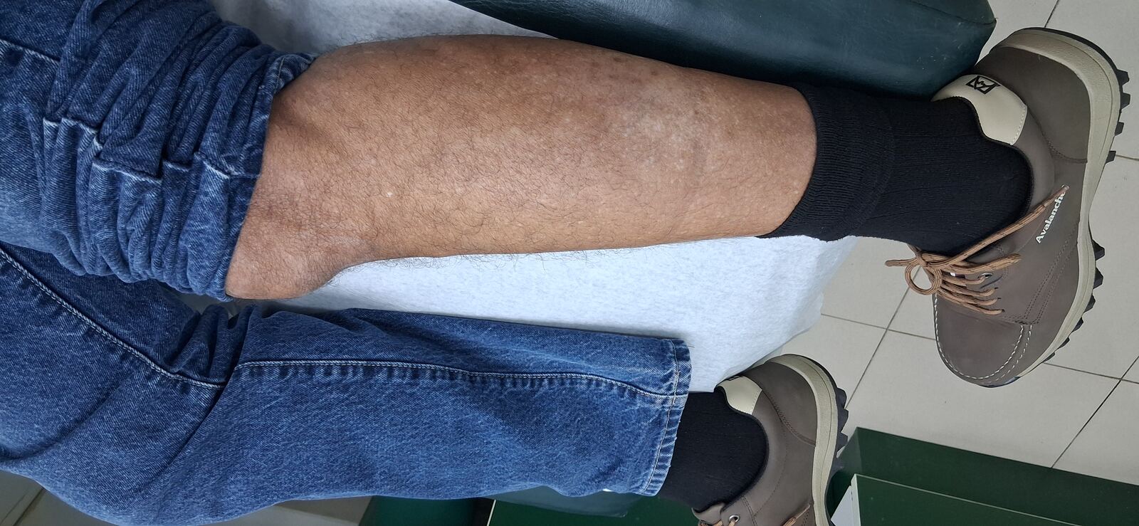 Neurodermatitis: imagen después