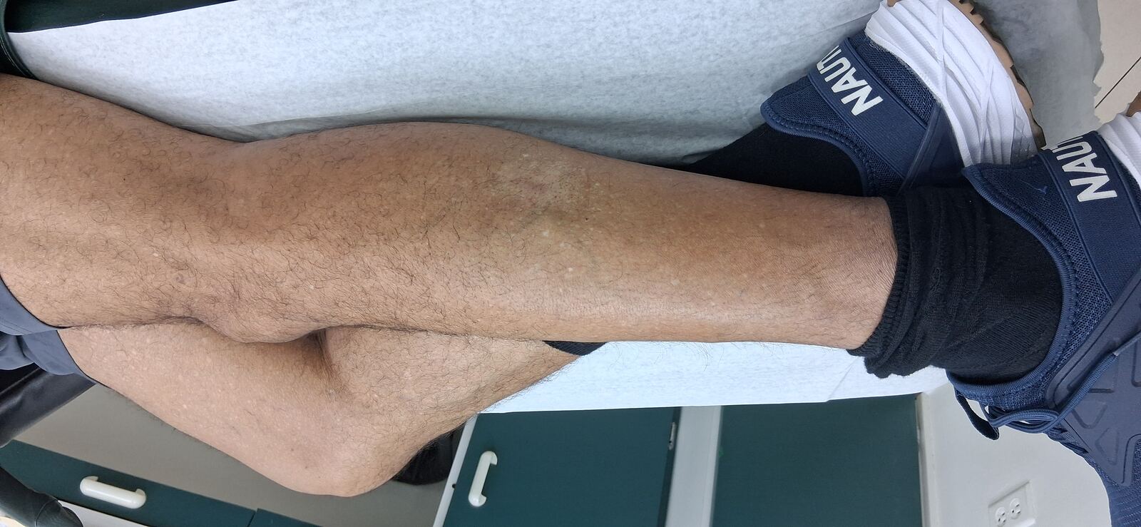 Caso clínico de Neurodermatitis
