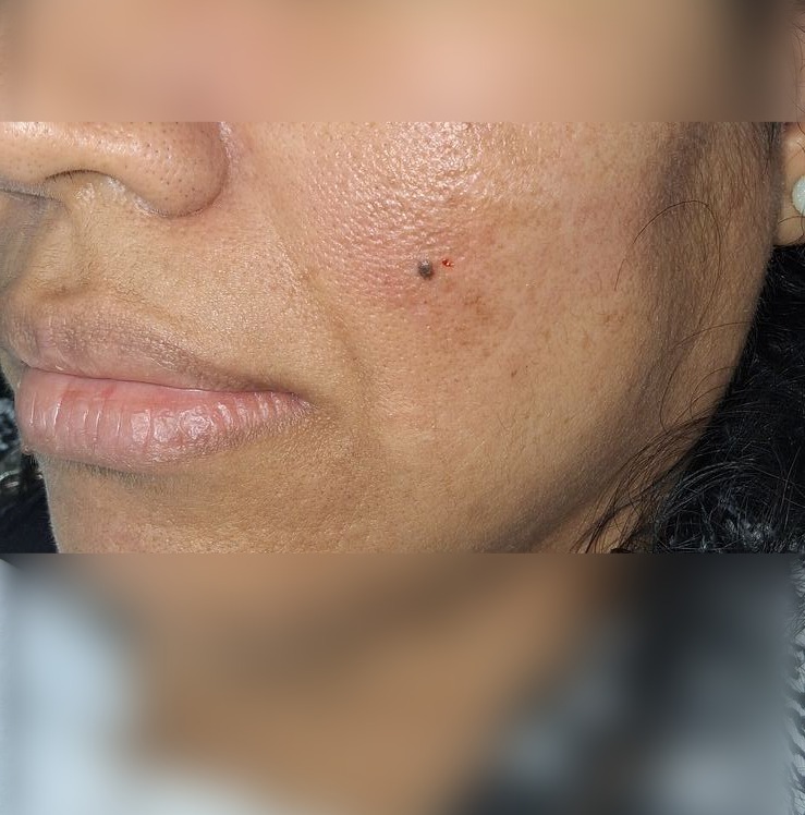 Nevus compuesto: imagen antes