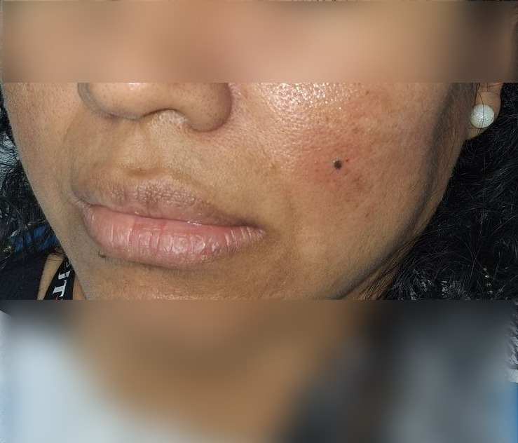 Caso clínico de Nevus compuesto