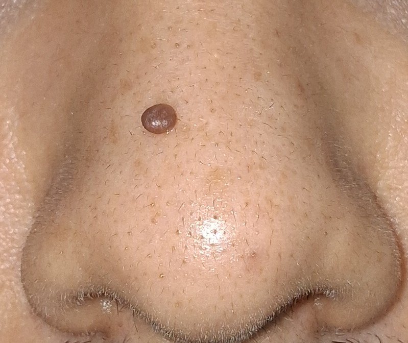 Nevus pedunculado: imagen antes