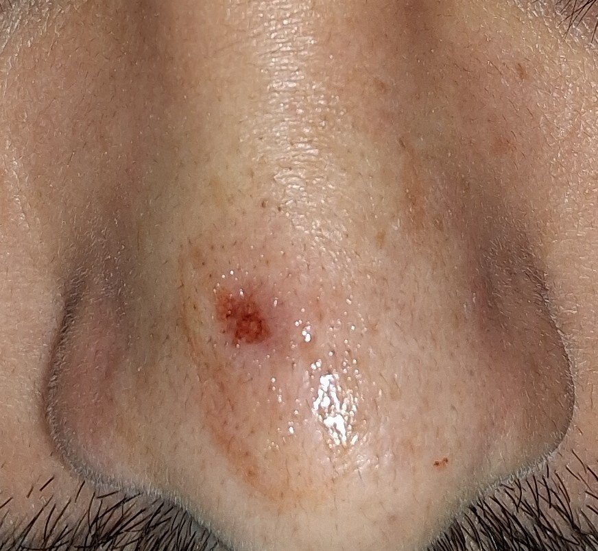Nevus pedunculado: imagen después