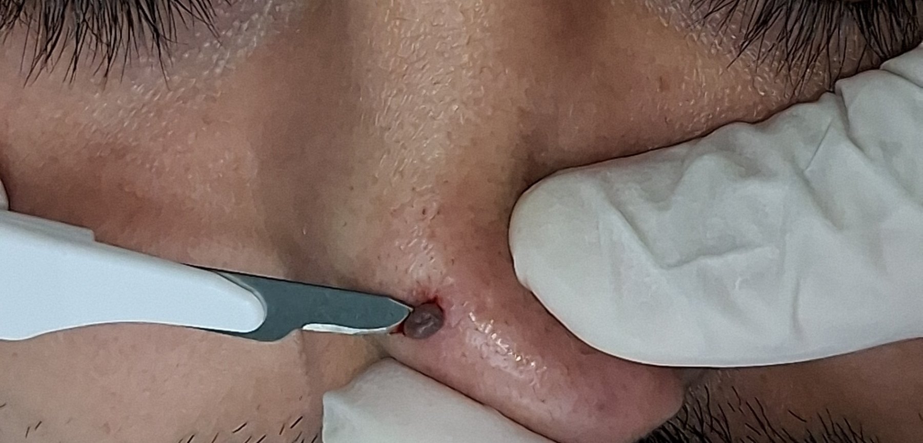 Caso clínico de Nevus pedunculado