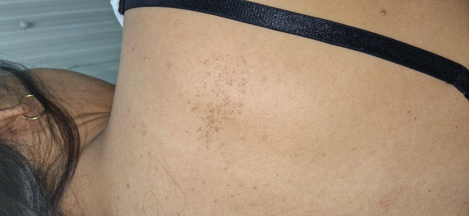 Caso clínico de Nevus spilus